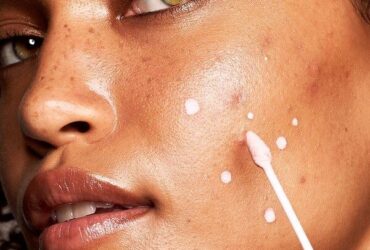 Fakta Yang Harus Kamu Ketahui Soal Acne Shaming Pada Perempuan Di Indonesia